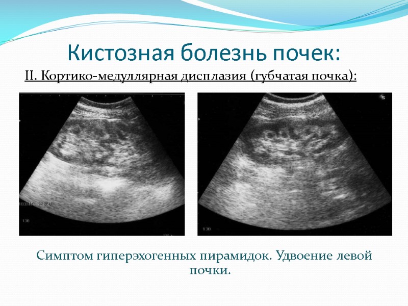 Кистозная болезнь почек: II. Кортико-медуллярная дисплазия (губчатая почка):      